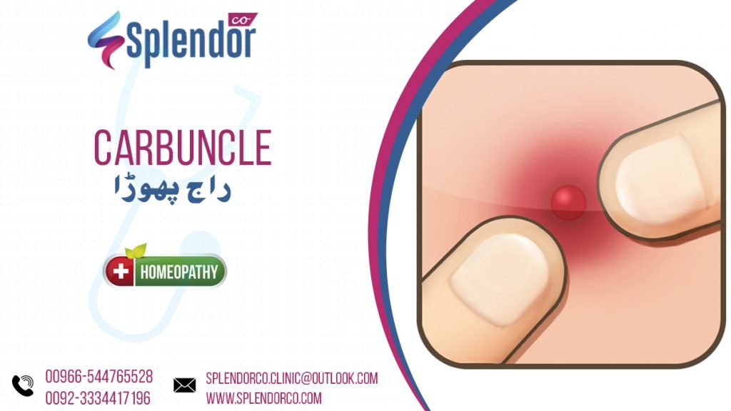 Homeopathic Treatment Carbuncle