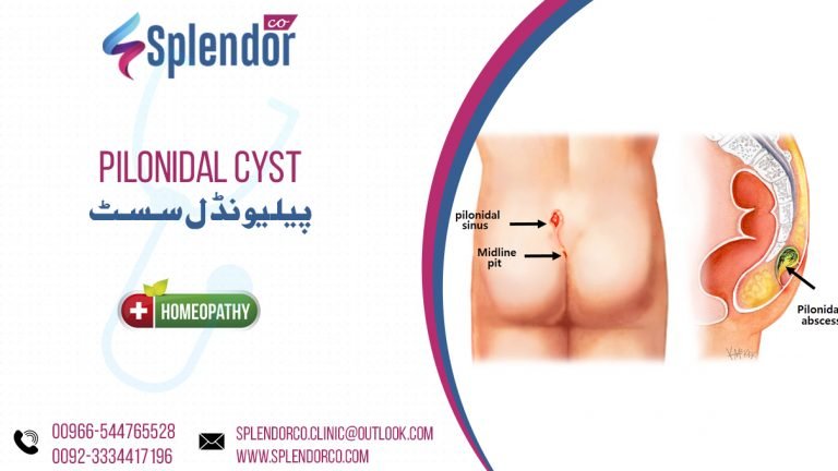 Homeopathic Medicines For Pilonidal Cyst