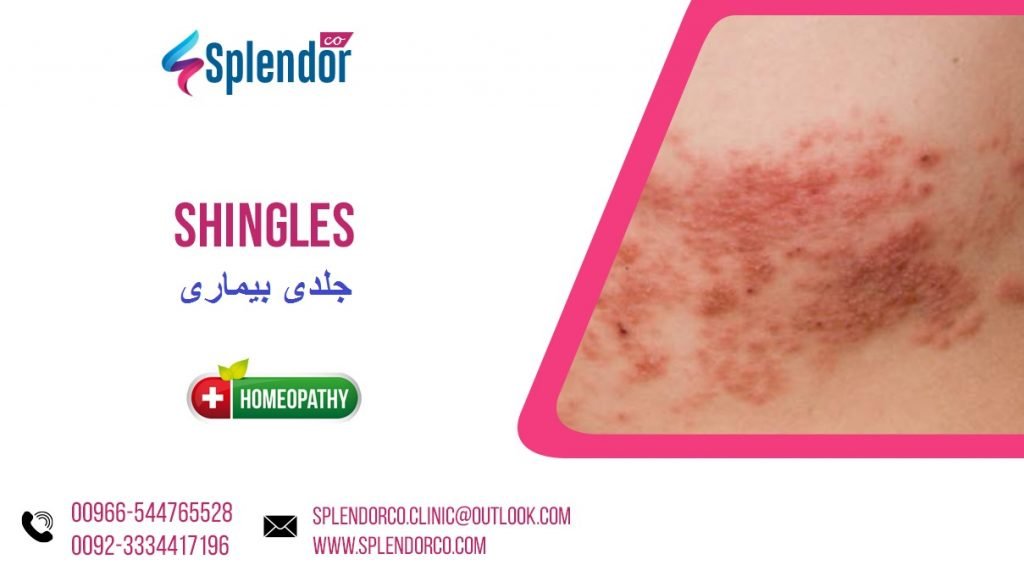 Homeopathic Medicines for Shingles